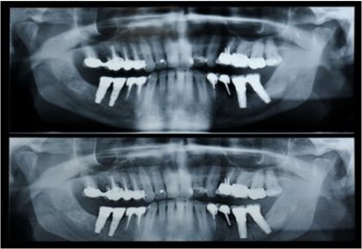 panorex dental x-ray images, Brookline, MA dentist